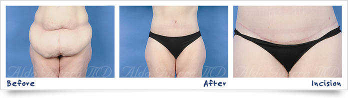 before, after, incision photo of extended tummy tuck