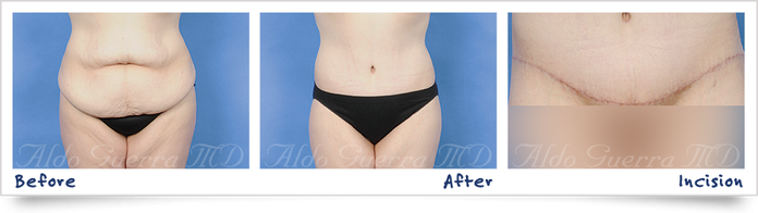 before, after, and incision photo of tummy tuck patient