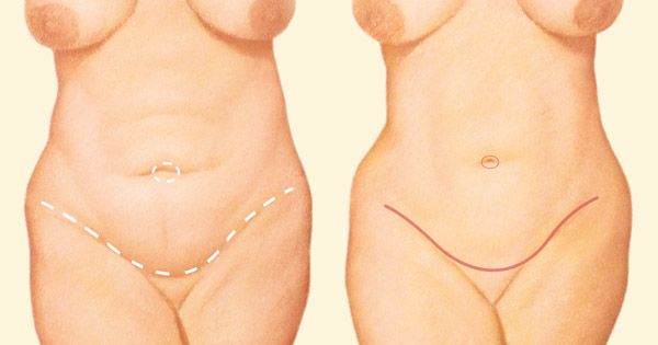 Tummy tuck incision line diagram