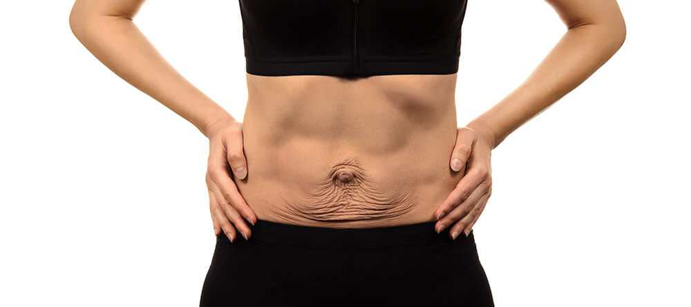 Woman belly Tummy Tuck flabby skin Female Body Abdomen. Alcohol