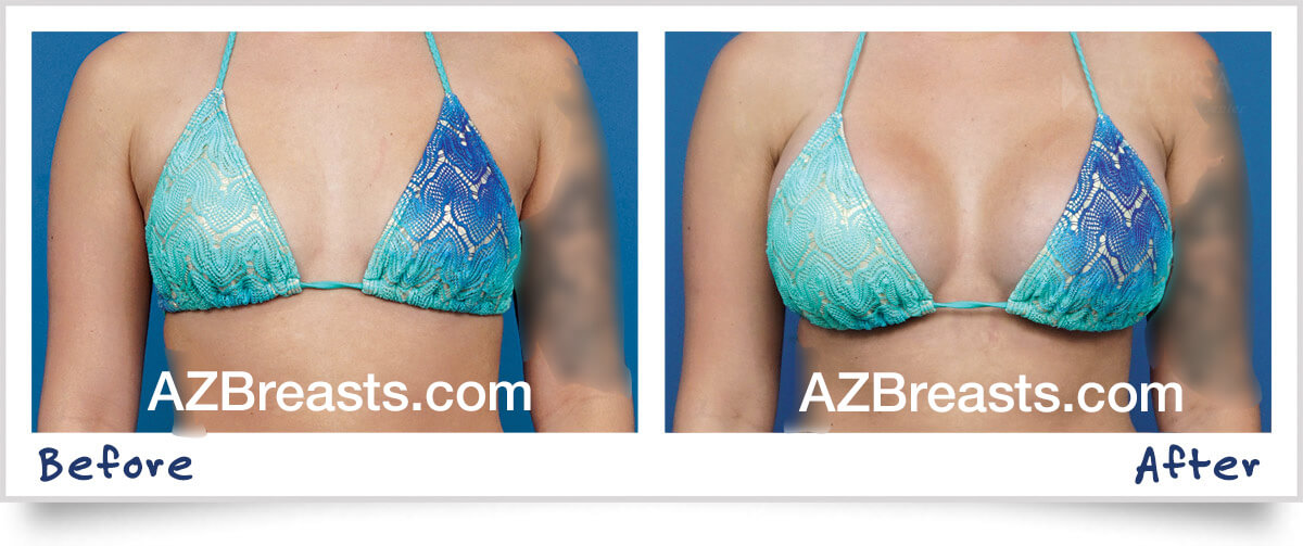 The Latest Mentor Breast Implants, And How To Avoid Dimples And