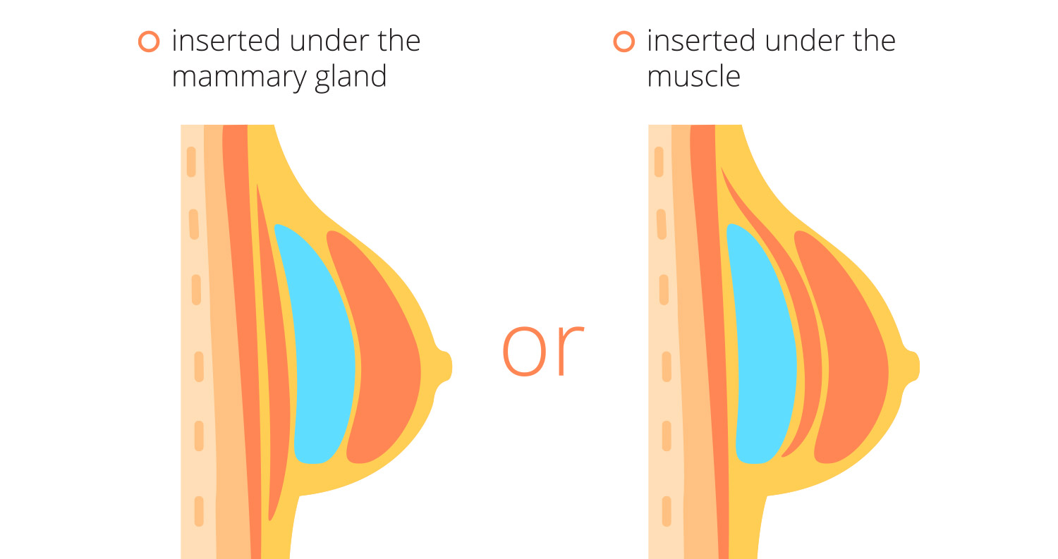 Should Your Breast Implants Be Under or Over the Muscle?