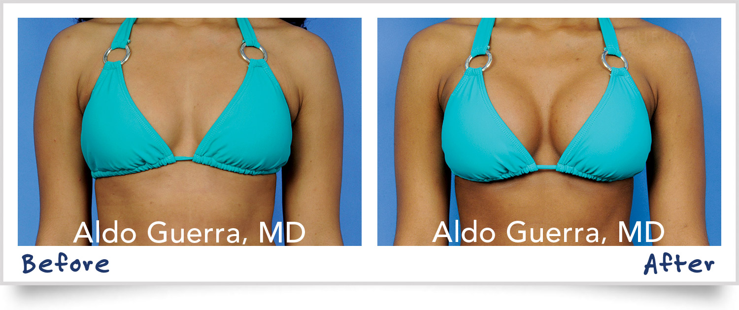 Breast Augmentation Choices for Runners