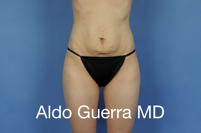 What Is a Mini Tummy Tuck in Chandler, AZ, and Is It Right for Me?